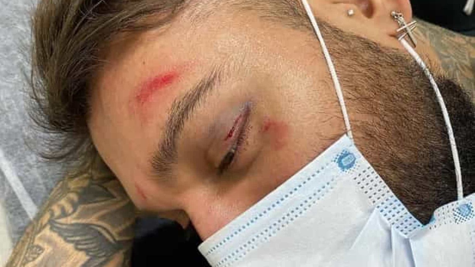 Lucas Lucco preocupa fãs após aparecer com o rosto machucado: 'Bebi demais'